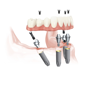 all on 4 treatment concept illustration all on 4 treatment concept illustration